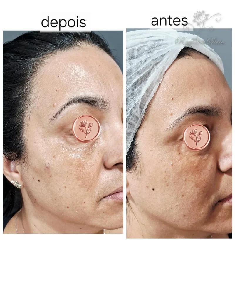 Antes e depois de Bioestimuladores de Colágeno — clínica Regiane Sieto, Ribeirão Preto