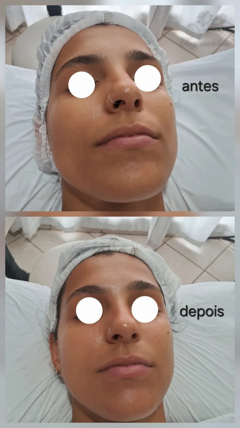 Antes e depois de Limpeza de Pele — clínica Regiane Sieto, Ribeirão Preto