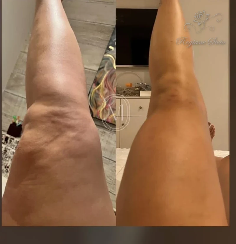 Protocolo para Lipedema em Ribeirão Preto — Regiane Sieto
