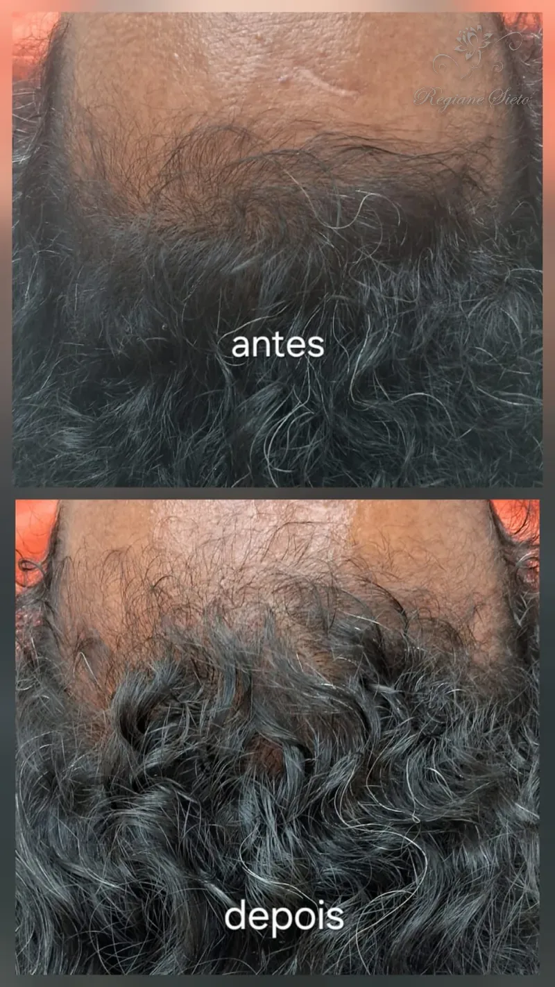 Antes e depois de Tratamento Capilar — Mesoterapia — clínica Regiane Sieto, Ribeirão Preto