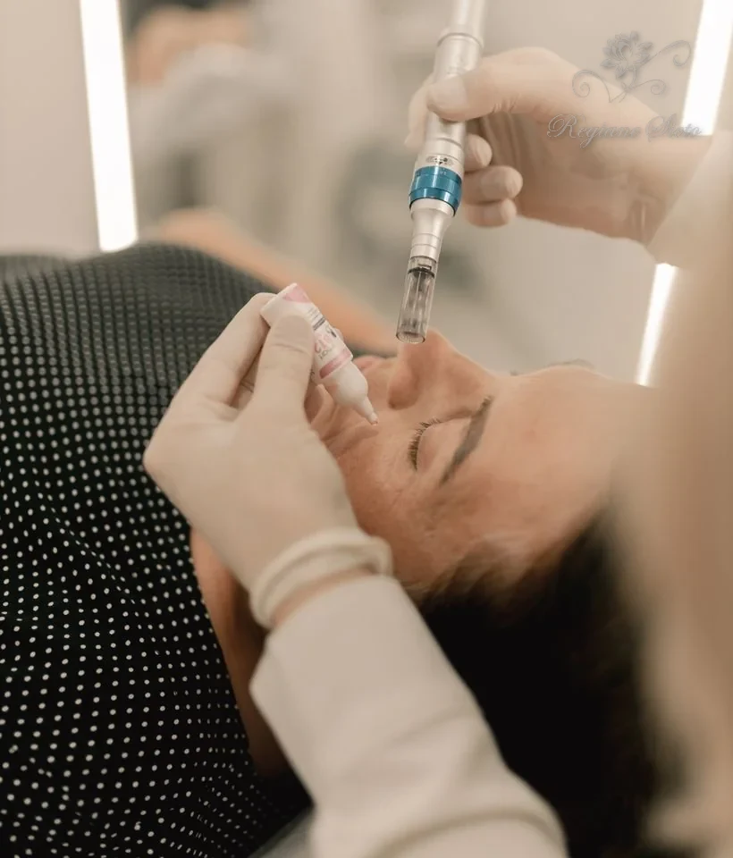 Microagulhamento Facial em Ribeirão Preto — Regiane Sieto