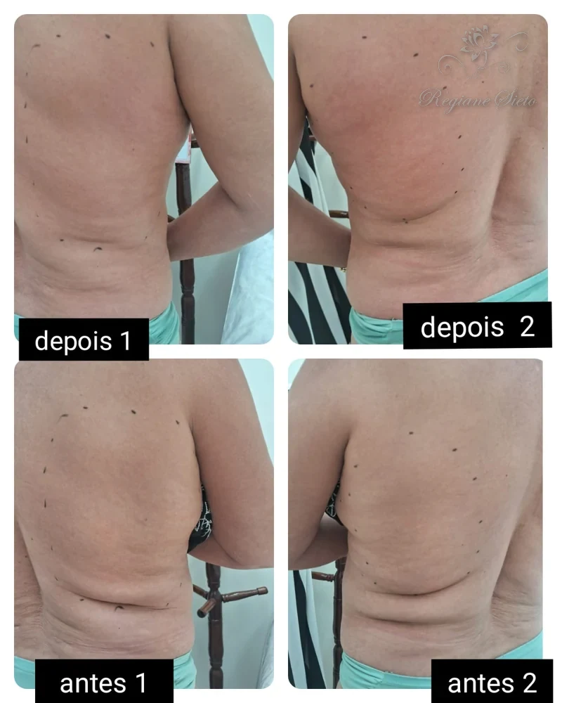 Antes e depois de Radiofrequência Corporal — clínica Regiane Sieto, Ribeirão Preto