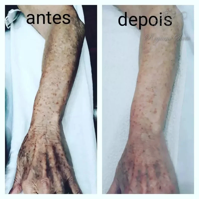 Antes e depois de Radiofrequência Corporal — clínica Regiane Sieto, Ribeirão Preto (1)