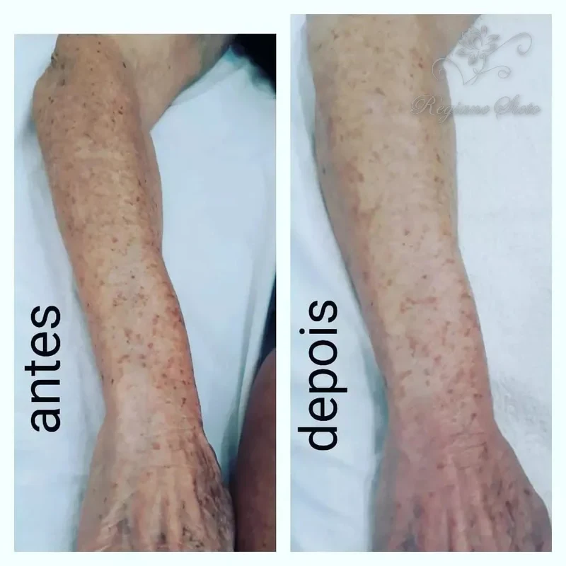 Antes e depois de Radiofrequência Corporal — clínica Regiane Sieto, Ribeirão Preto (2)