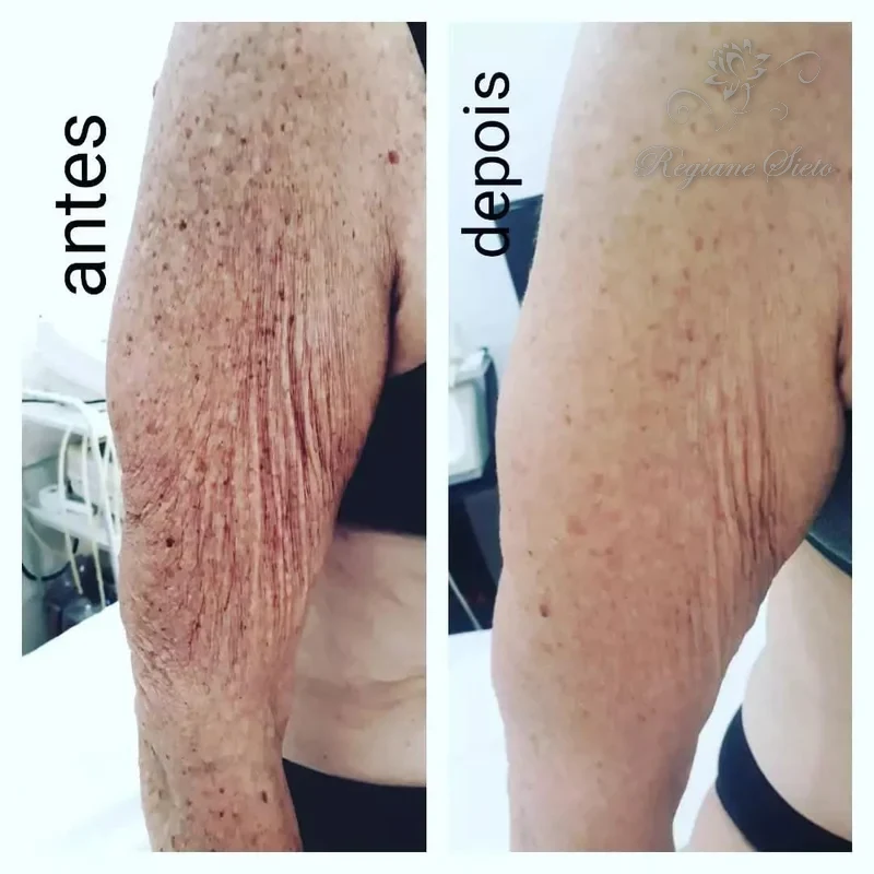 Antes e depois de Radiofrequência Corporal — clínica Regiane Sieto, Ribeirão Preto (3)