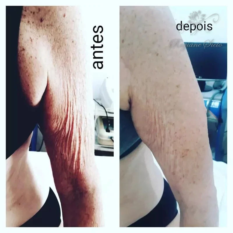 Antes e depois de Radiofrequência Corporal — clínica Regiane Sieto, Ribeirão Preto (4)