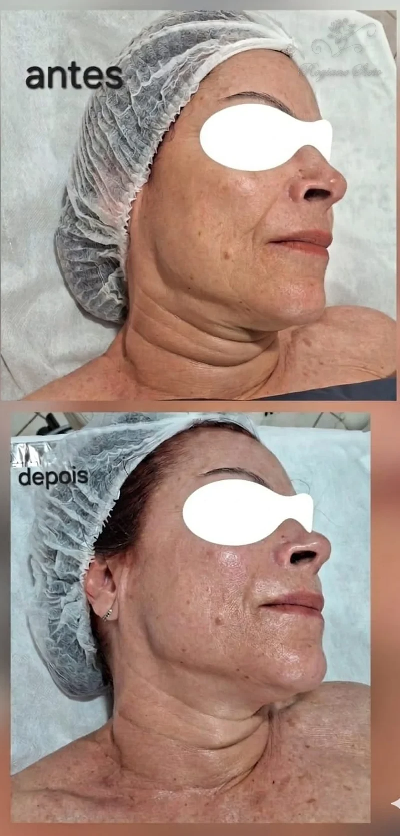 Antes e depois de Radiofrequência Facial — clínica Regiane Sieto, Ribeirão Preto