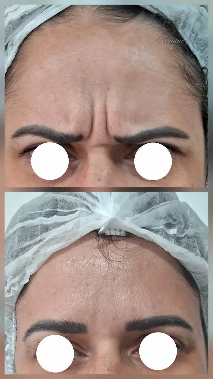 Antes e depois de toxina botulínica na testa — clínica Regiane Sieto, Ribeirão Preto (1)