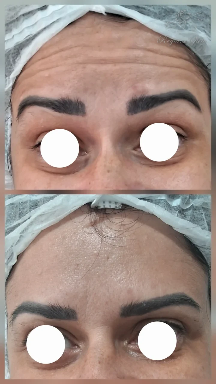 Antes e depois de toxina botulínica na testa — clínica Regiane Sieto, Ribeirão Preto (2)