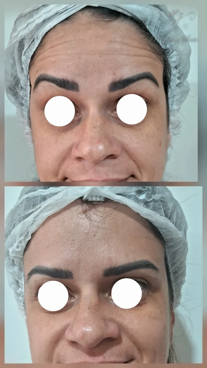 Antes e depois de toxina botulínica na glabela — clínica Regiane Sieto, Ribeirão Preto (3)